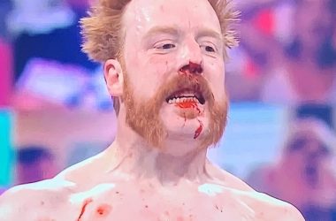 Sheamus underwent second nose surgery on Wednesday