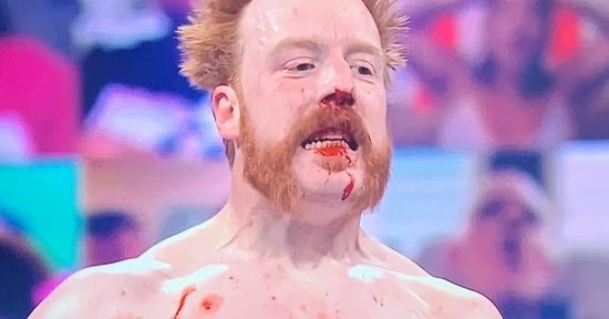 Sheamus underwent second nose surgery on Wednesday
